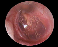滲出性中耳炎（左鼓膜）